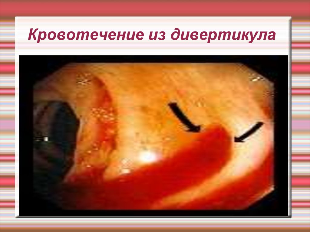 Образование свищей