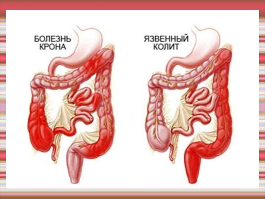Воспалительные заболевания толстой кишки