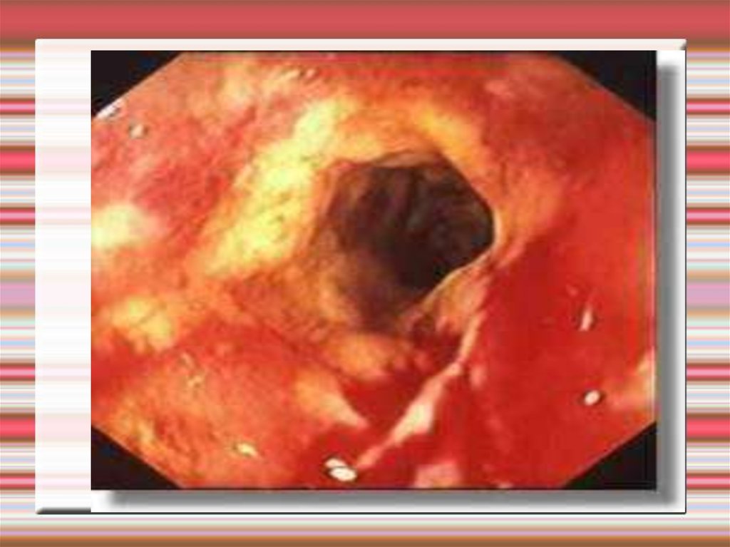 Болезнь Крона