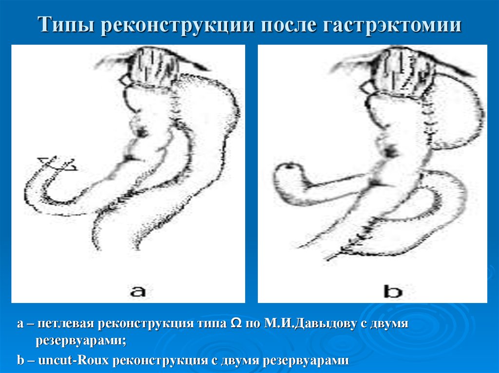 Гастрэктомия по сигалу схема