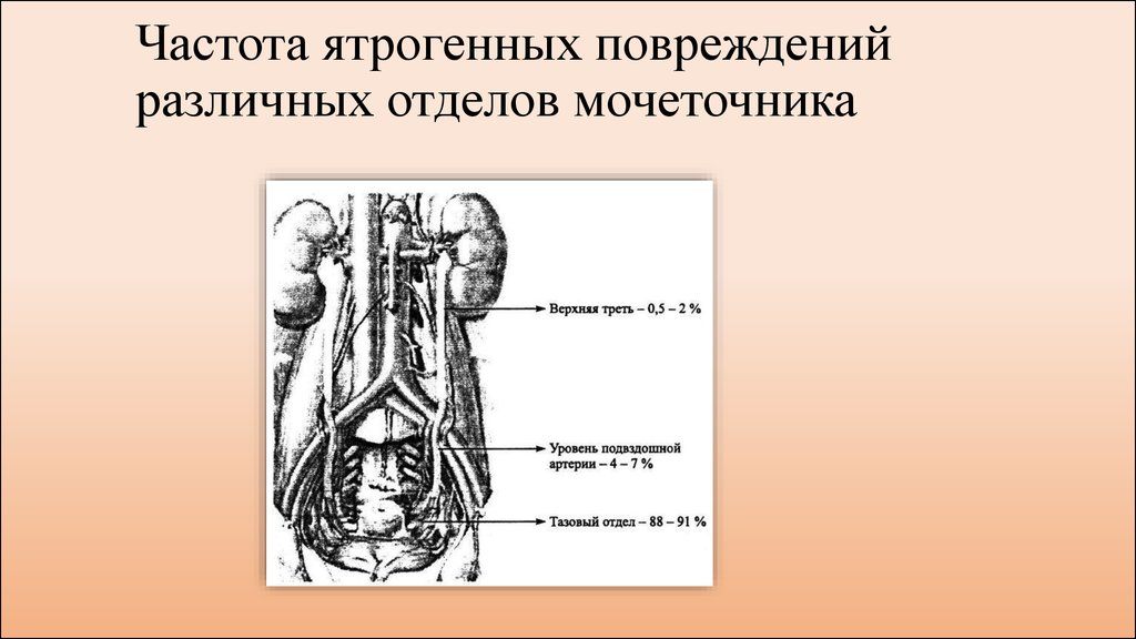 Травмы мочеточника презентация