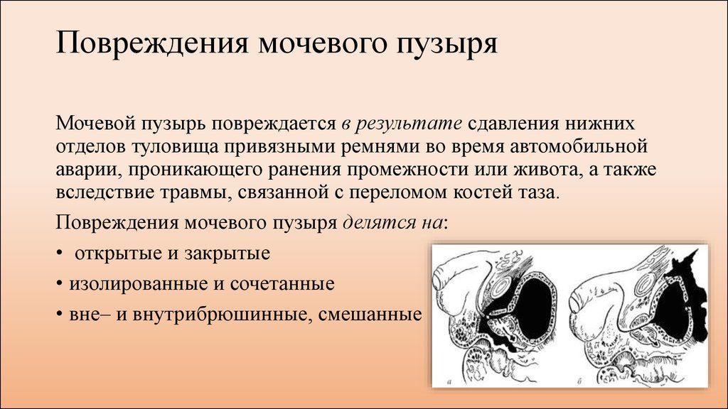 Травмы уретры презентация