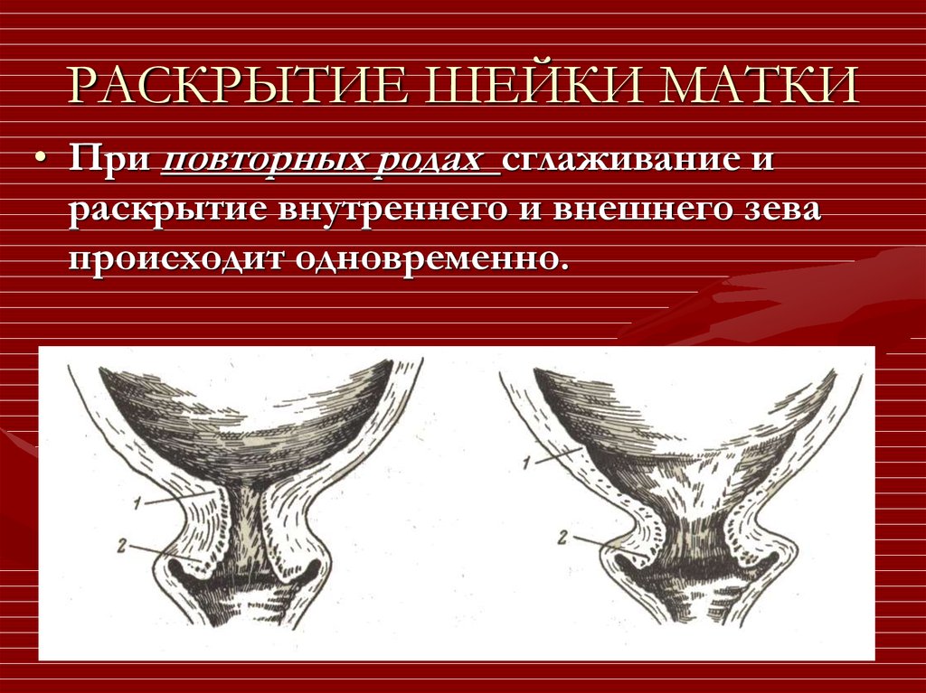 Гинекология шейка. Раскрытие шейной матки. Раскрытие шейки матки. Раскрытие внутреннего зева.