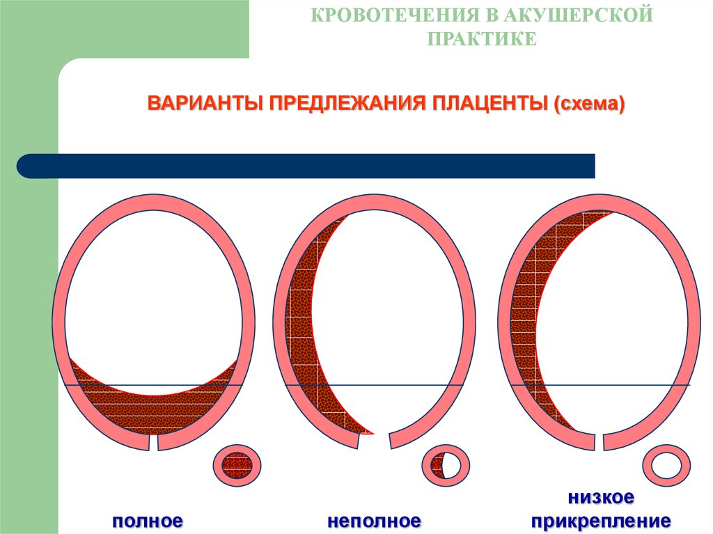 Акушерское кровотечение картинки