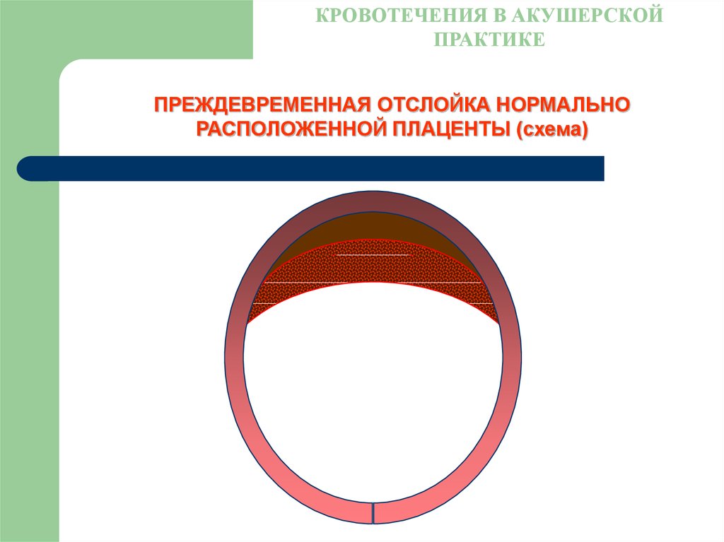 Контракционное кольцо в акушерстве. Кровотечения в акушерской практике. Контракционное кольцо. Акушерские кровотечения схема. Контракционное кольцо в акушерстве это.