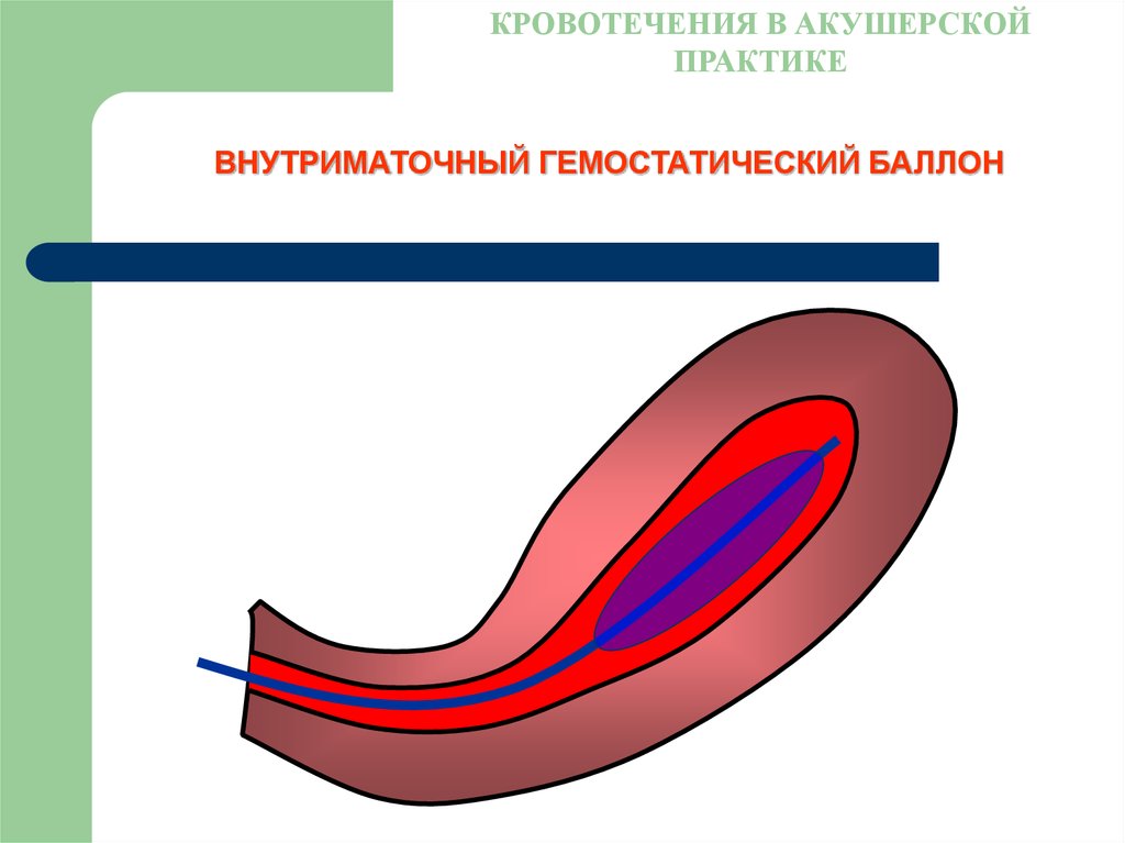 Акушерское кровотечение картинки