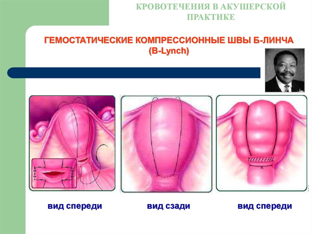 Кровотечение в акушерстве презентация