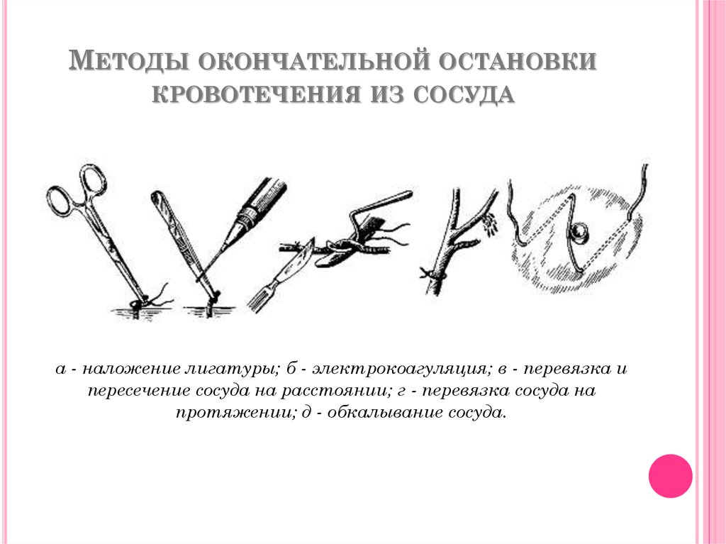 Перевязка в ране и на протяжении. Метод окончательной остановки кровотечения. Механические методы окончательной остановки кровотечения. Механический метод окончательной остановки кровотечения.