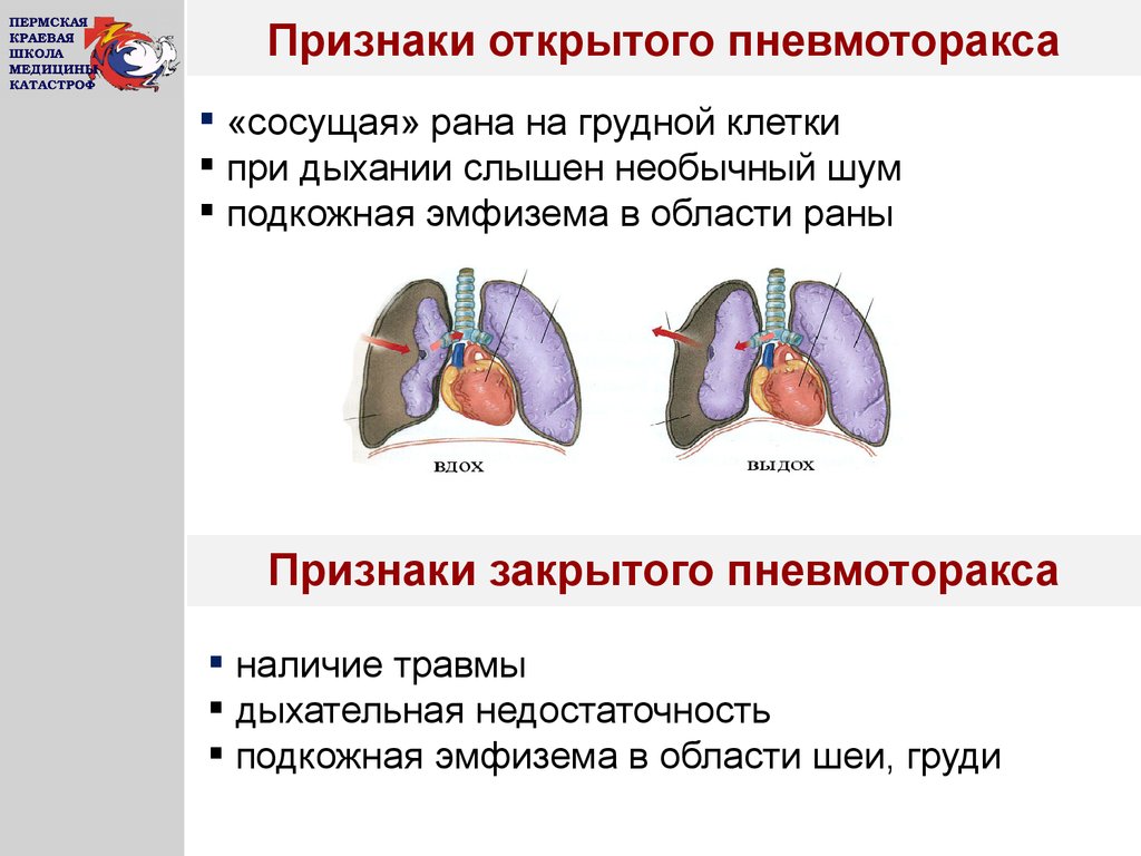 Открытый пневмоторакс. Отличительный признак открытого пневмоторакса. Симптомы открытого пневмоторакса. Клинические симптомы пневмоторакса. Клинические проявления открытого пневмоторакса.