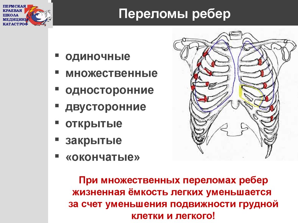 Могут ли ребра. Переломы ребер классификация. Одиночный перелом ребер.