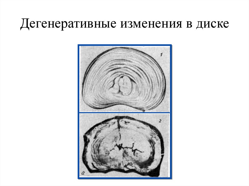 Дегенеративные изменения. Дегенеративное изменение диска. Дегенеративные изменения клапанов. Дегенеративные изменения створок.