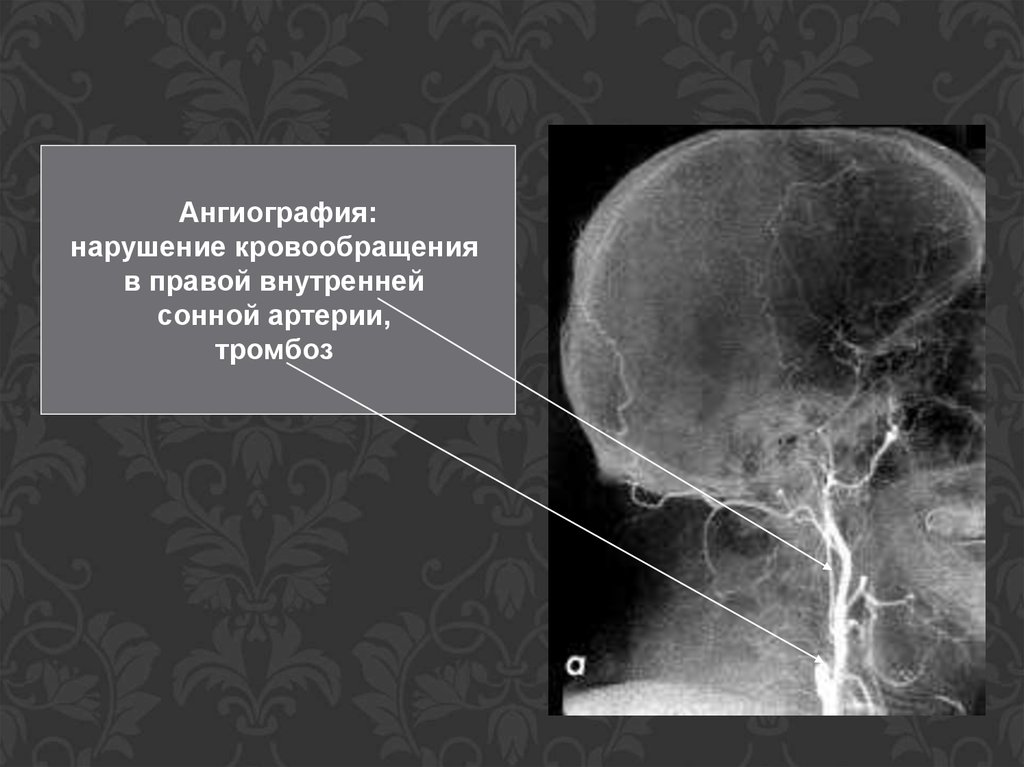 Тромбоз артерий мозга. Ангиография сонных артерий. Тромбоз внутренней сонной артерии кт. Признак тромбоза внутренней сонной артерии. Ангиография нарушение кровообращения.