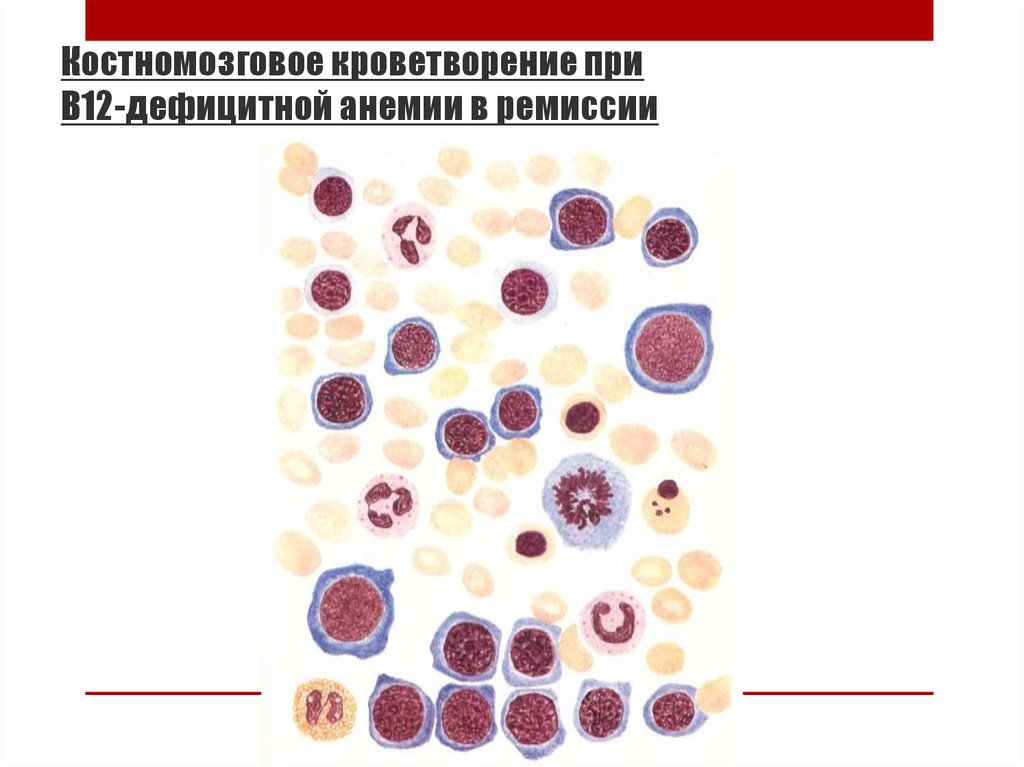 Фолиевая дефицитная анемия презентация