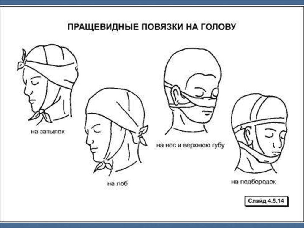 Техника наложения пращевидной повязки. Схема наложения пращевидной повязки. Пращевидная повязка на затылок. Пращевидная повязка на лоб.