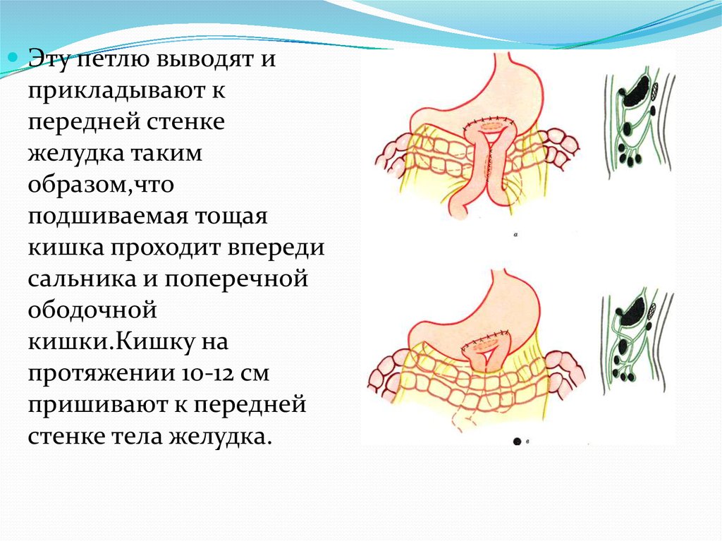 Передние и задние гастроэнтероанастомозы - презентация онлайн