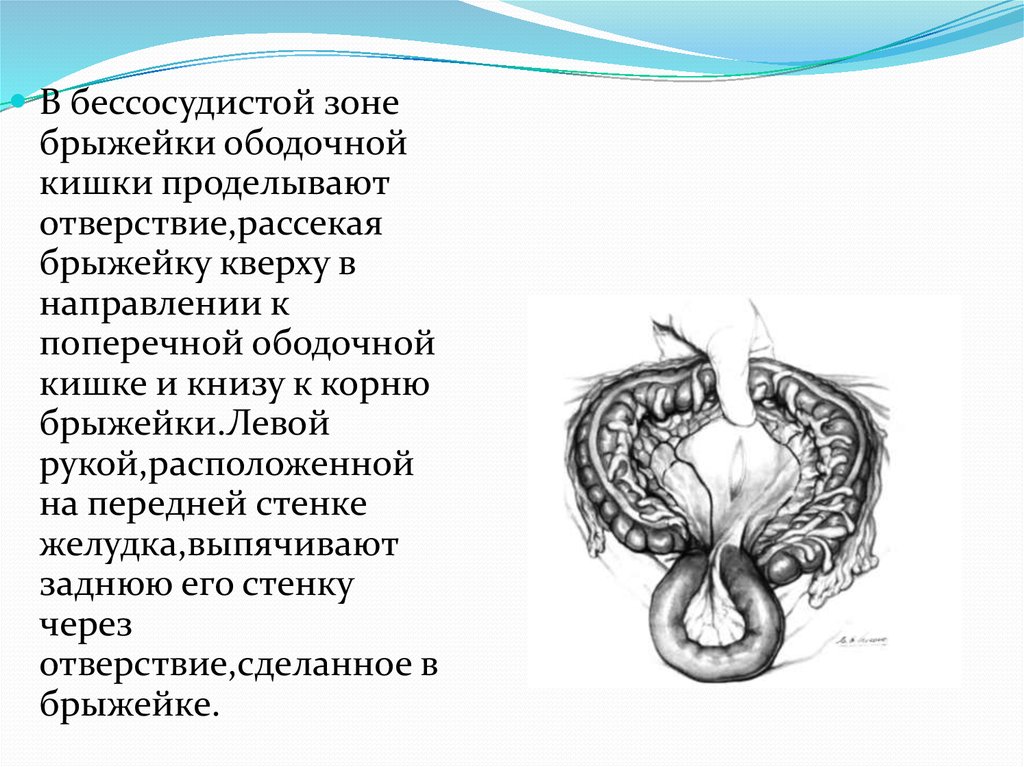 Передние и задние гастроэнтероанастомозы - презентация онлайн