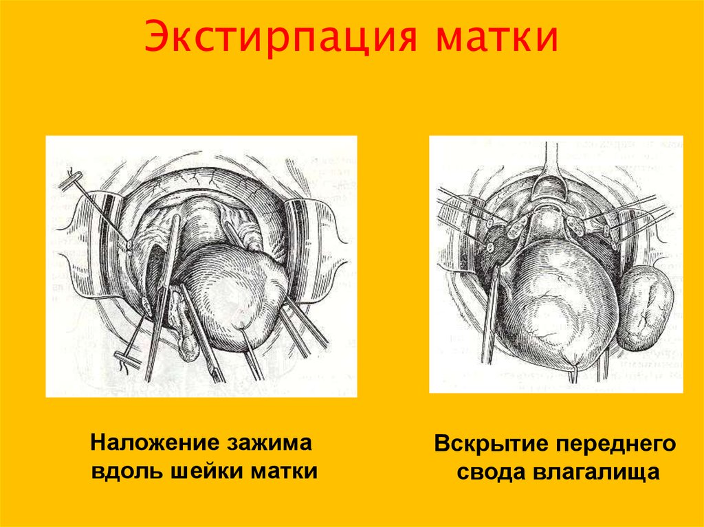 Экстирпация матки и ампутация матки разница. Влагалищная экстирпация матки. Влагалищная экстирпация этапы операции. Экстрафасциальная экстирпация матки. Ампутация матки с придатками.