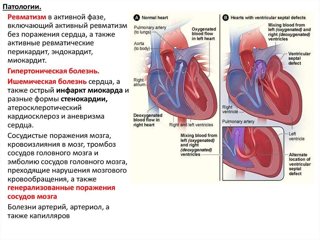 Активная фаза ревматизма