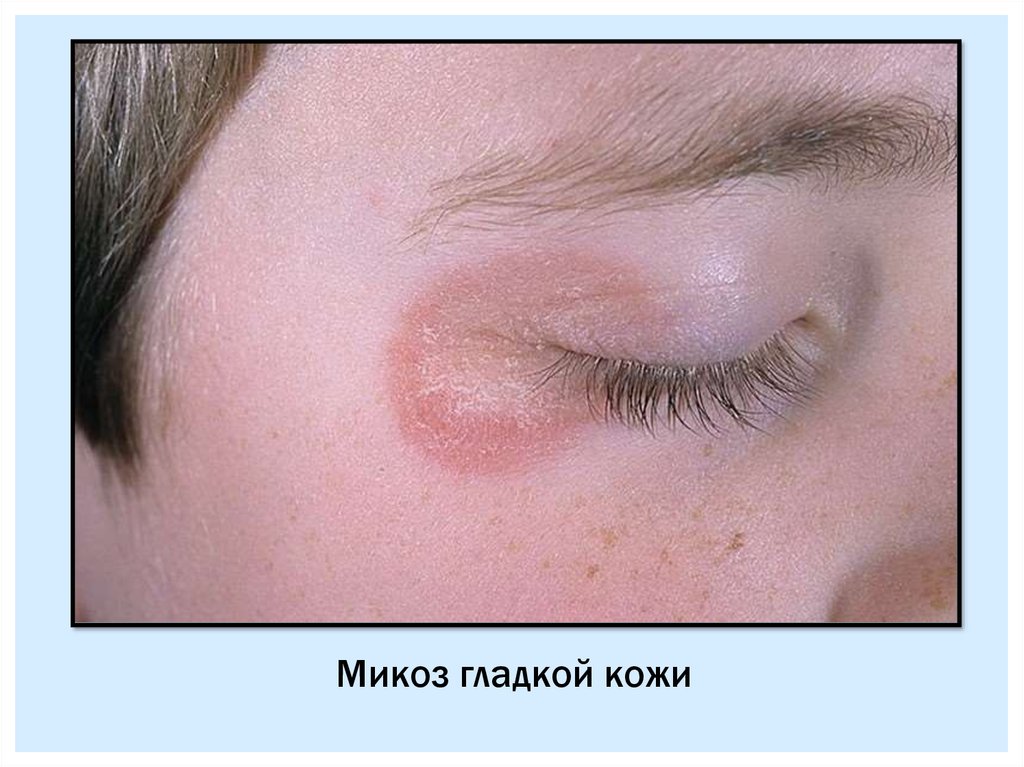 Микозы. Классификация - презентация онлайн