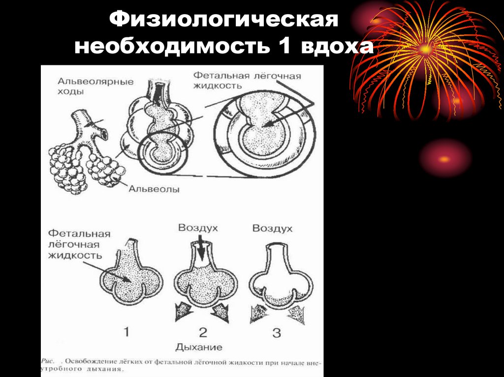 Схема первого вдоха новорожденного