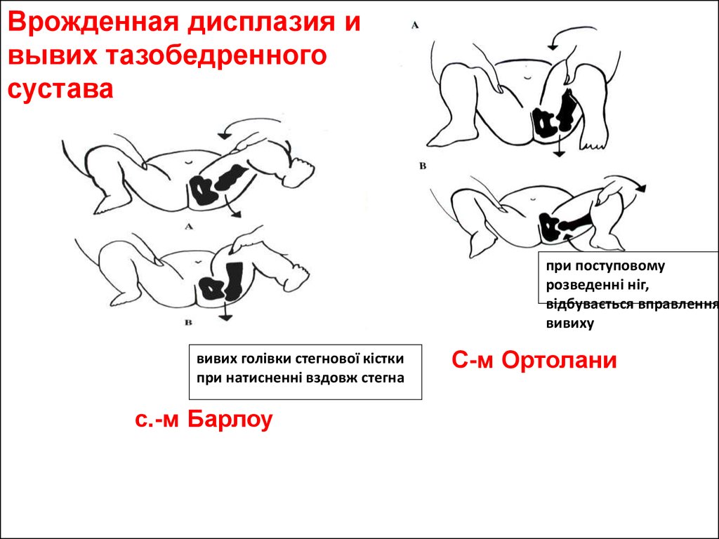 Схема врожденного вывиха бедра