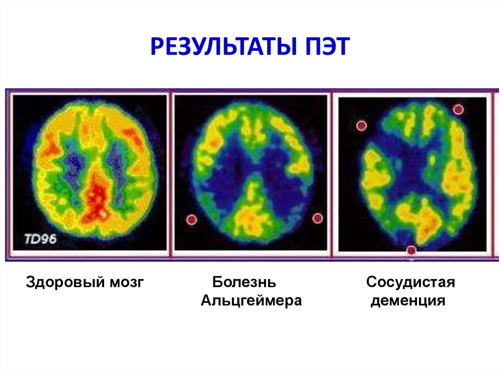 Пэт с тирозином. ПЭТ кт головного мозга. Петкате головного мозга. Позитронно-эмиссионная томография мозга. Позитронно эмиссионная томография болезнь Альцгеймера.