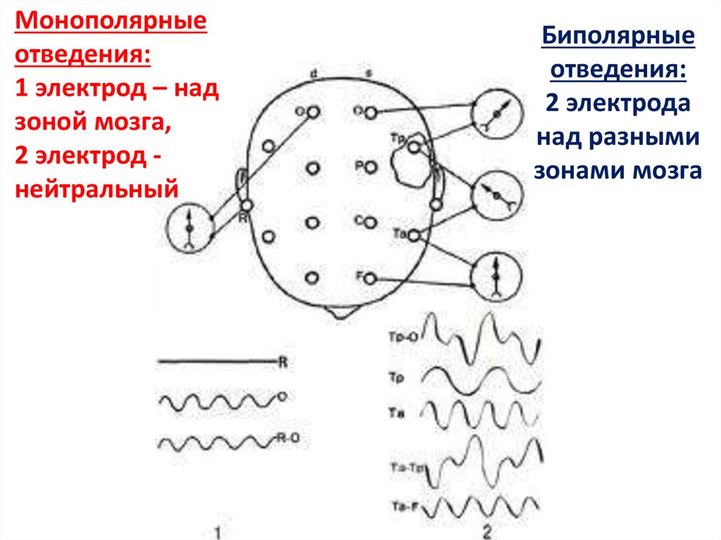 Схема наложения электродов при ээг рисунок памятка