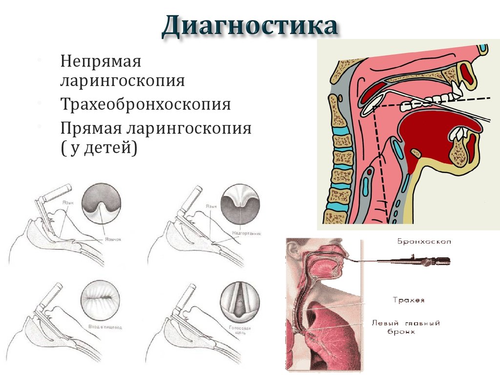 Ларингоскопия это