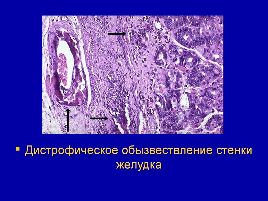 Обызвествление. Кальциноз сосудов патанатомия. Трихинеллез мышц (дистрофическое обызвествление) микропрепарат. Обызвествление это патанатомия. Дистрофическое обызвествление.