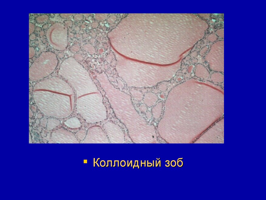 Коллоидная щитовидная железа. Узловой коллоидный зоб гистология. Макрофолликулярный коллоидный зоб микропрепарат. Узловой коллоидный зоб микропрепарат. Коллоидный зоб препарат патанатомия.