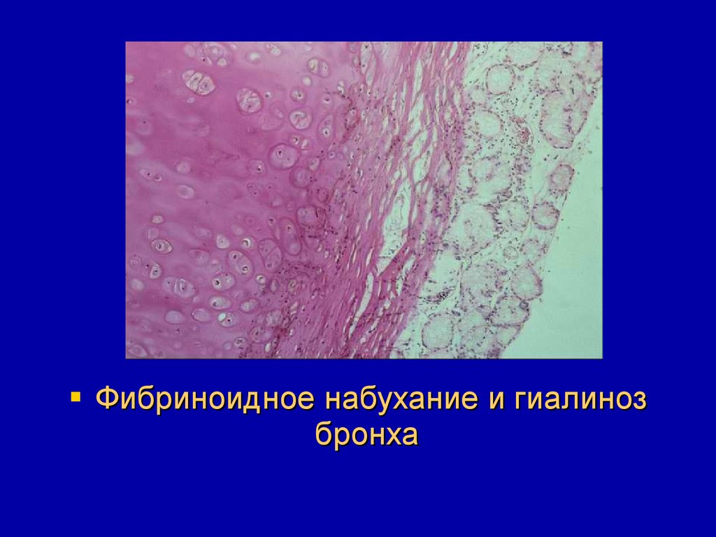 Фибриноидное набухание это. Фибриноидное набухание патанатомия. Фибриноидное набухание микроскопическая картина. Фибриноидное набухание соединительной ткани при ревматизме. Микропрепараты фибриноидное набухание.