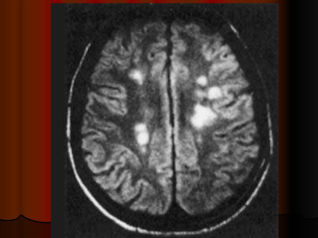Многоочаговые поражения головного