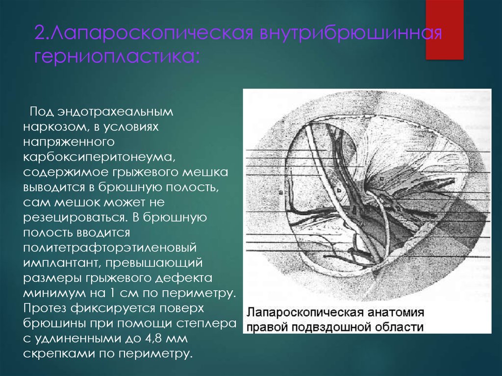 Герниопластика. Протокол операции лапароскопическая герниопластика. Лапароскопическая внутрибрюшинная герниопластика. Герниопластика брюшной полости. Герниопластика диафрагмальных грыж.