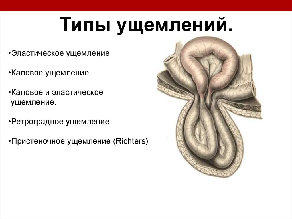 Ответы ущемленная грыжа. Эластическое ущемление грыжи. Ущемленная грыжа эластическая. Эластическое ущемление грыж живота. Ущемленная грыжа живота.