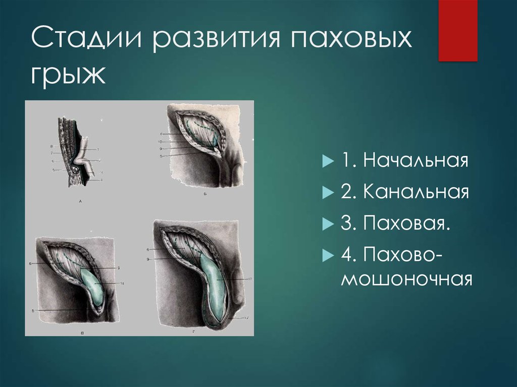 Паховая грыжа. Стадии развития паховой грыжи. Стадии развития паховых грыж. Стадии формирования паховой грыжи.