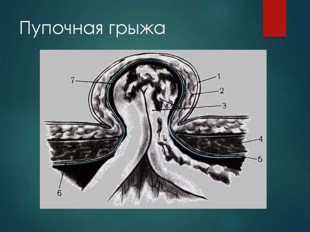 Презентация грыжи живота хирургия