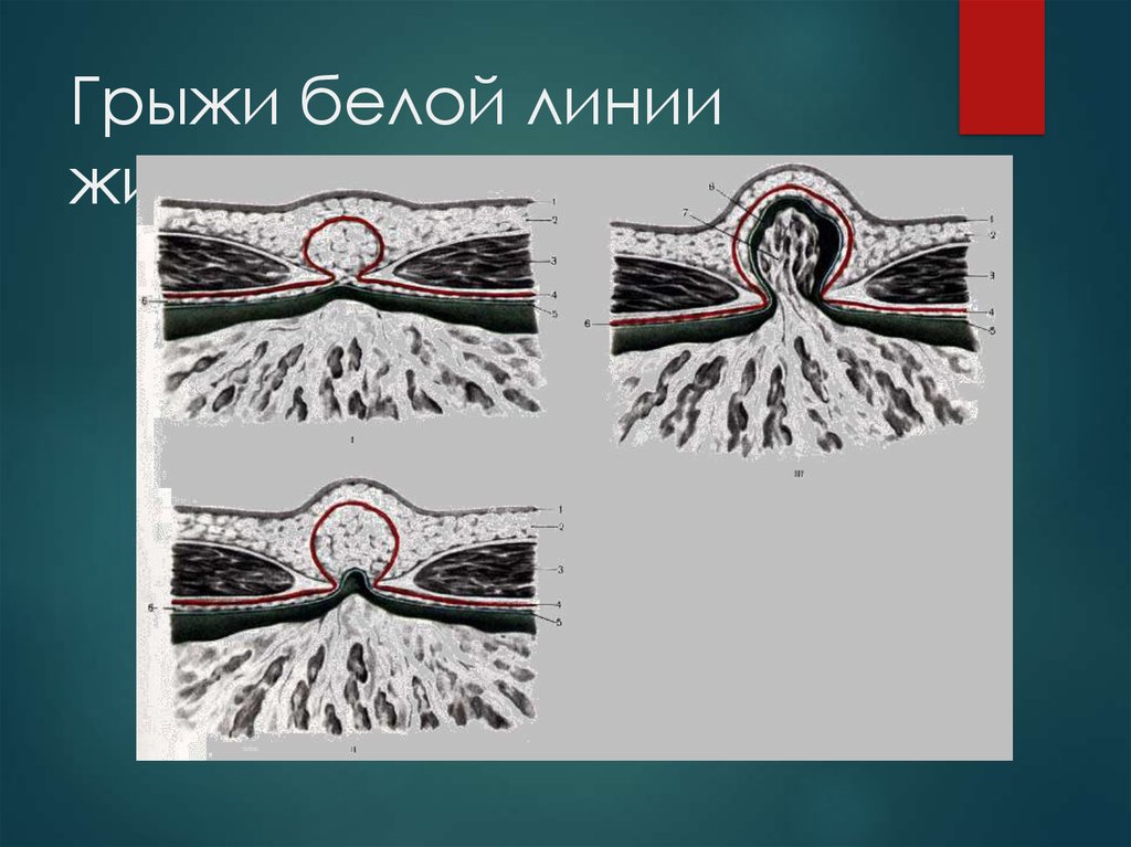 Презентация грыжи живота хирургия