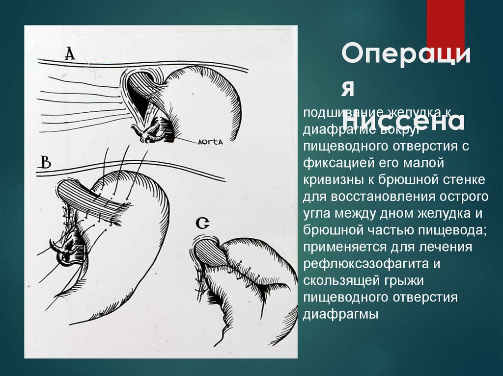 Грыжи пищеводного отверстия диафрагмы презентация по хирургии