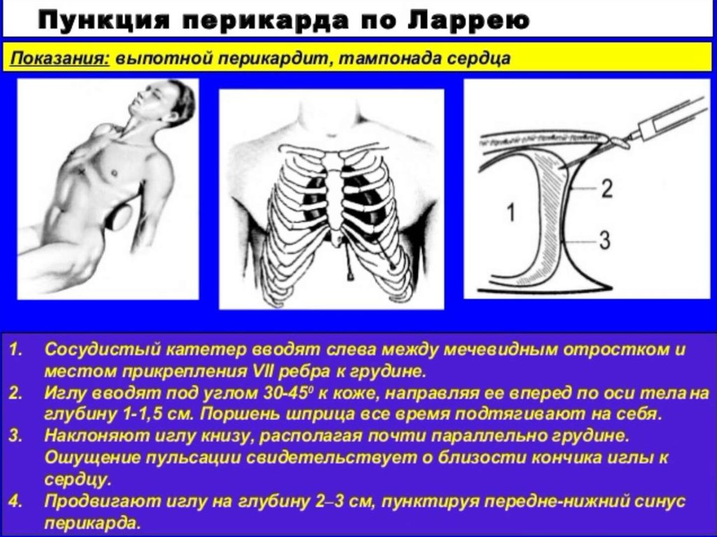 Передний нижний синус перикарда