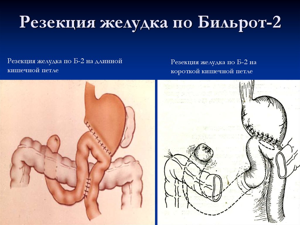 Резекция желудка по бальфуру схема