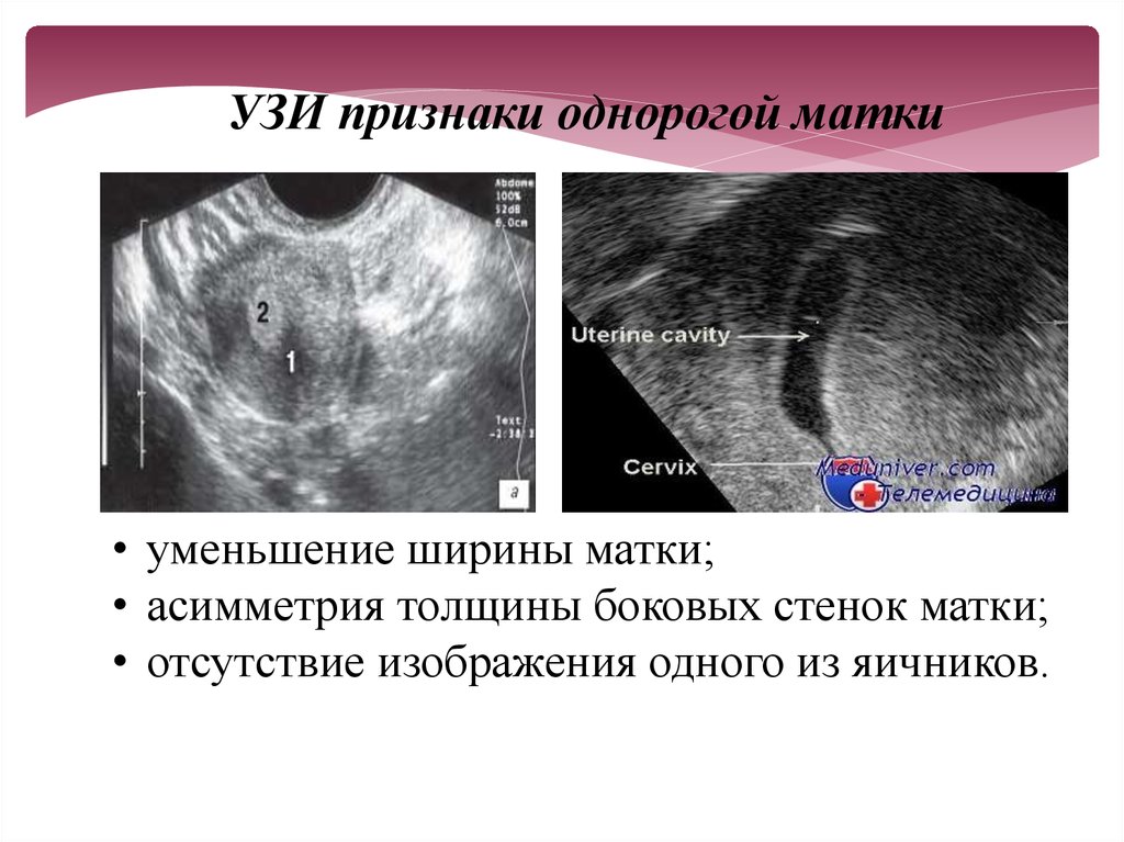 Рог матки. Рудиментарный Рог на матке на УЗИ. Двурогая матка УЗИ признаки.