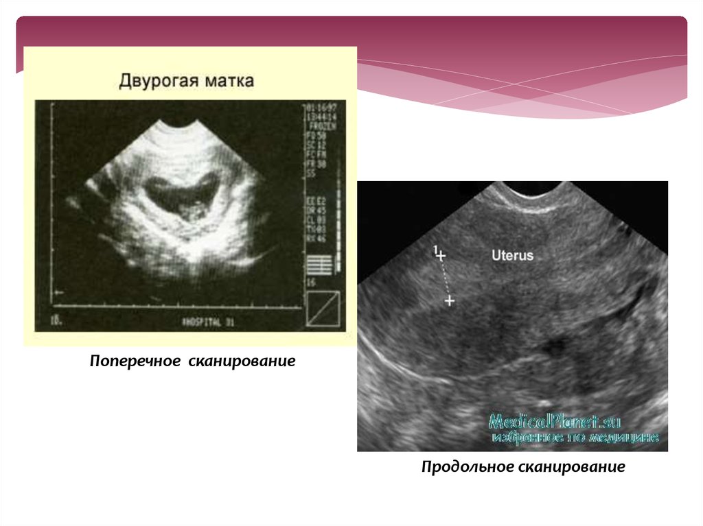 Что такое двурогая матка. Двурогая матка на УЗИ. Продольное и поперечное сканирование в УЗИ. Аномалия матки двурогая. Двурогая матка и беременность.