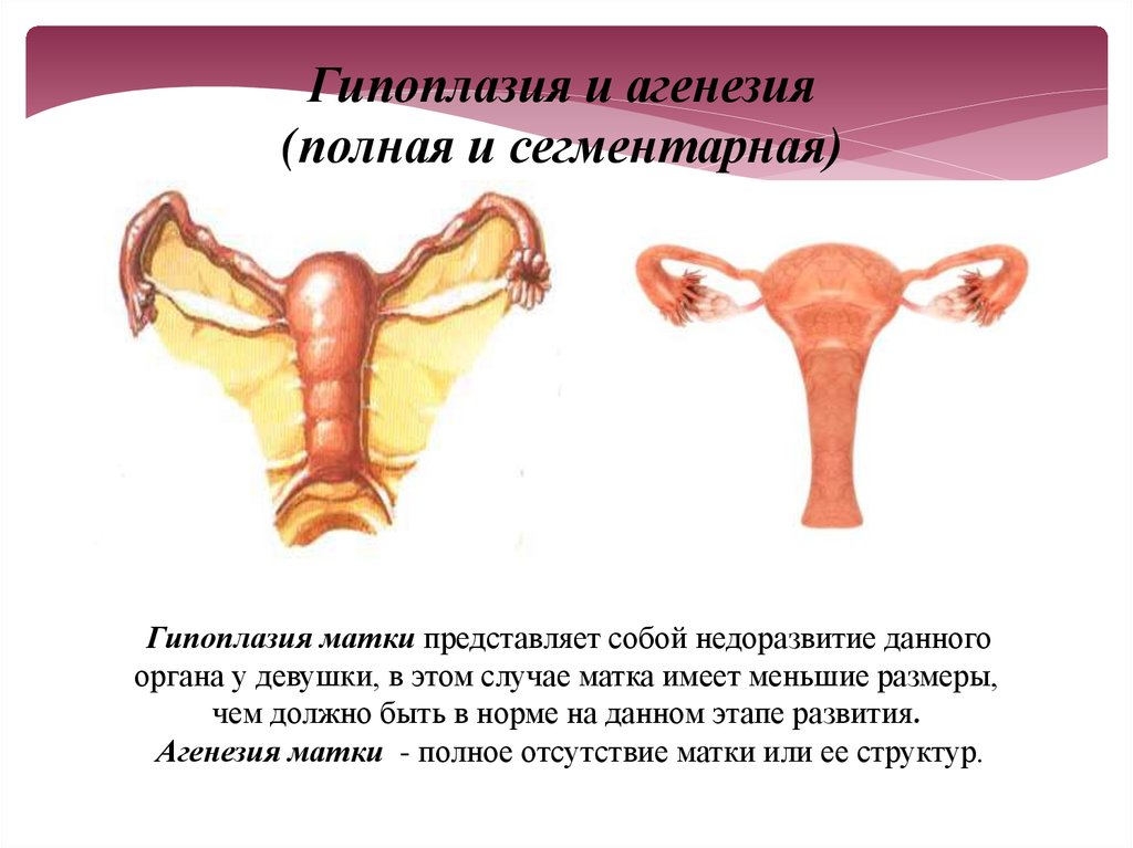 Матка девочки. Гипоплазия наружных половых органов.