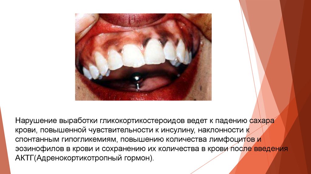 Болезнь аддисона презентация