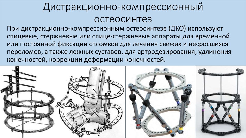 Внеочаговый остеосинтез презентация