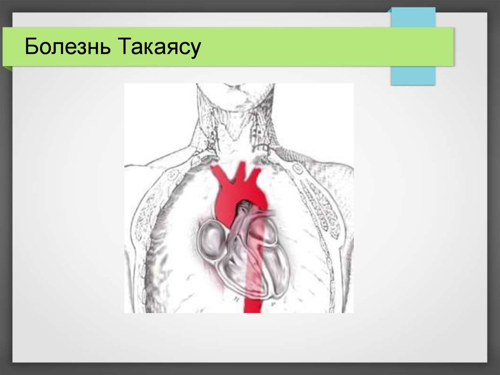 Синдром такаясу презентация