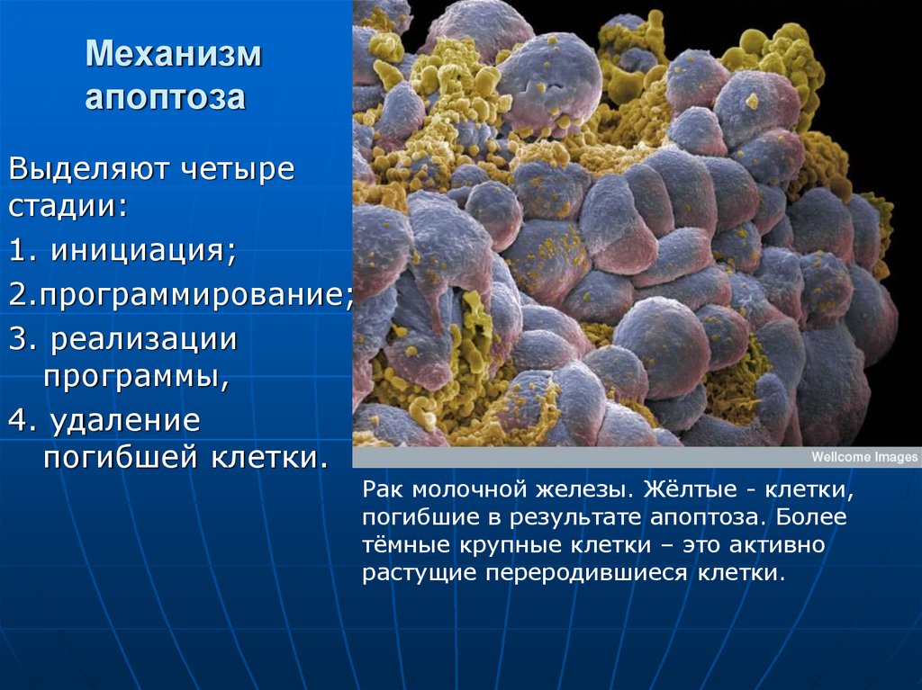 Стадии раковых клеток. Апоптоз раковой клетки. Аутоптоз раковых клеток. Механизм развития апоптоза. Стадии апоптоза клетки.