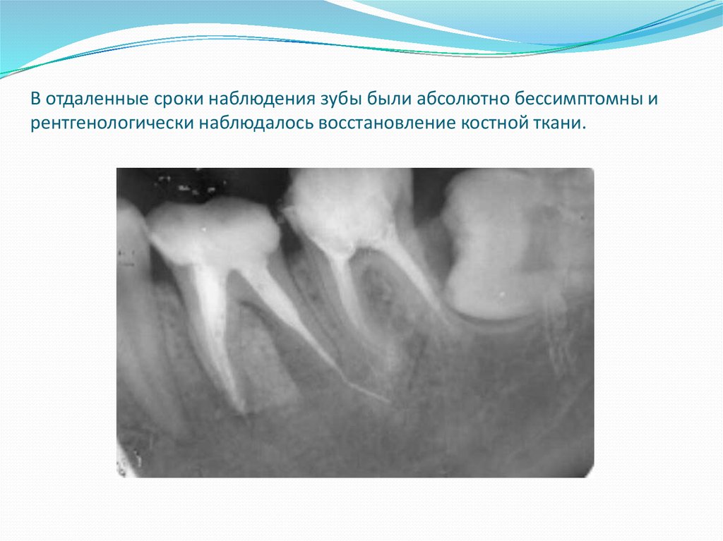 Восстановление костной ткани зубов. Сроки восстановления костной ткани.