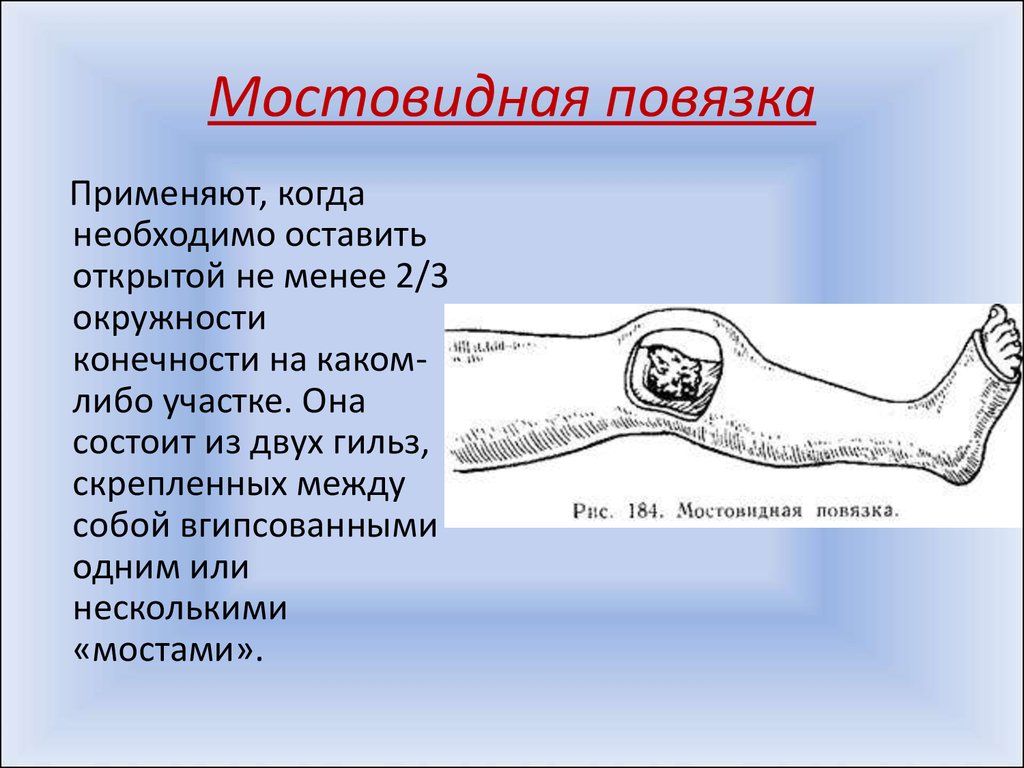 Применение гипсовой повязки ученый. Мостовидная гипсовая повязка. Мостовидные гипсовые повязки. Циркулярная гипсовая повязка. Лонгетно циркулярная повязка.