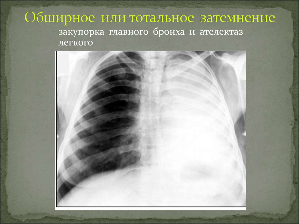 Затемнение в легких на флюорографии что это. Ателектаз правого легкого рентген. Синдром обширного затемнения рентген. Ограниченное затемнение легочного поля рентген. Рентген тотальное затемнение легкого.